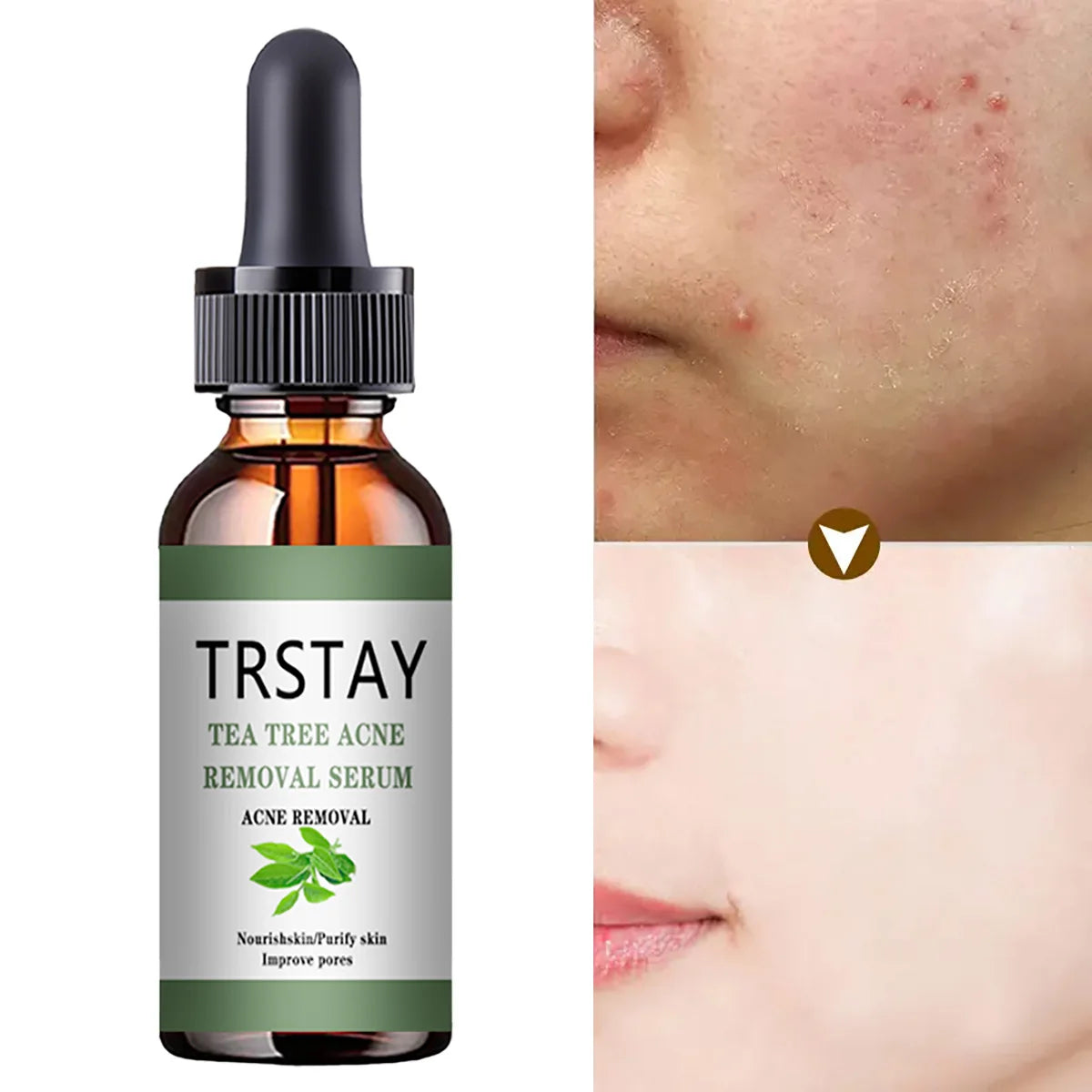 Acne Treatment Face Serum