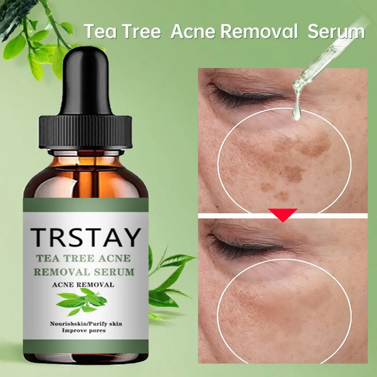 Acne Treatment Face Serum