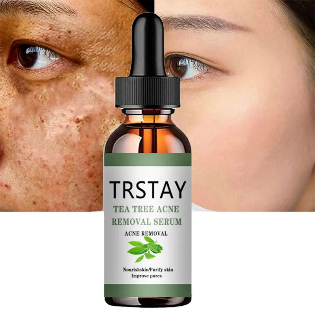 Acne Treatment Face Serum