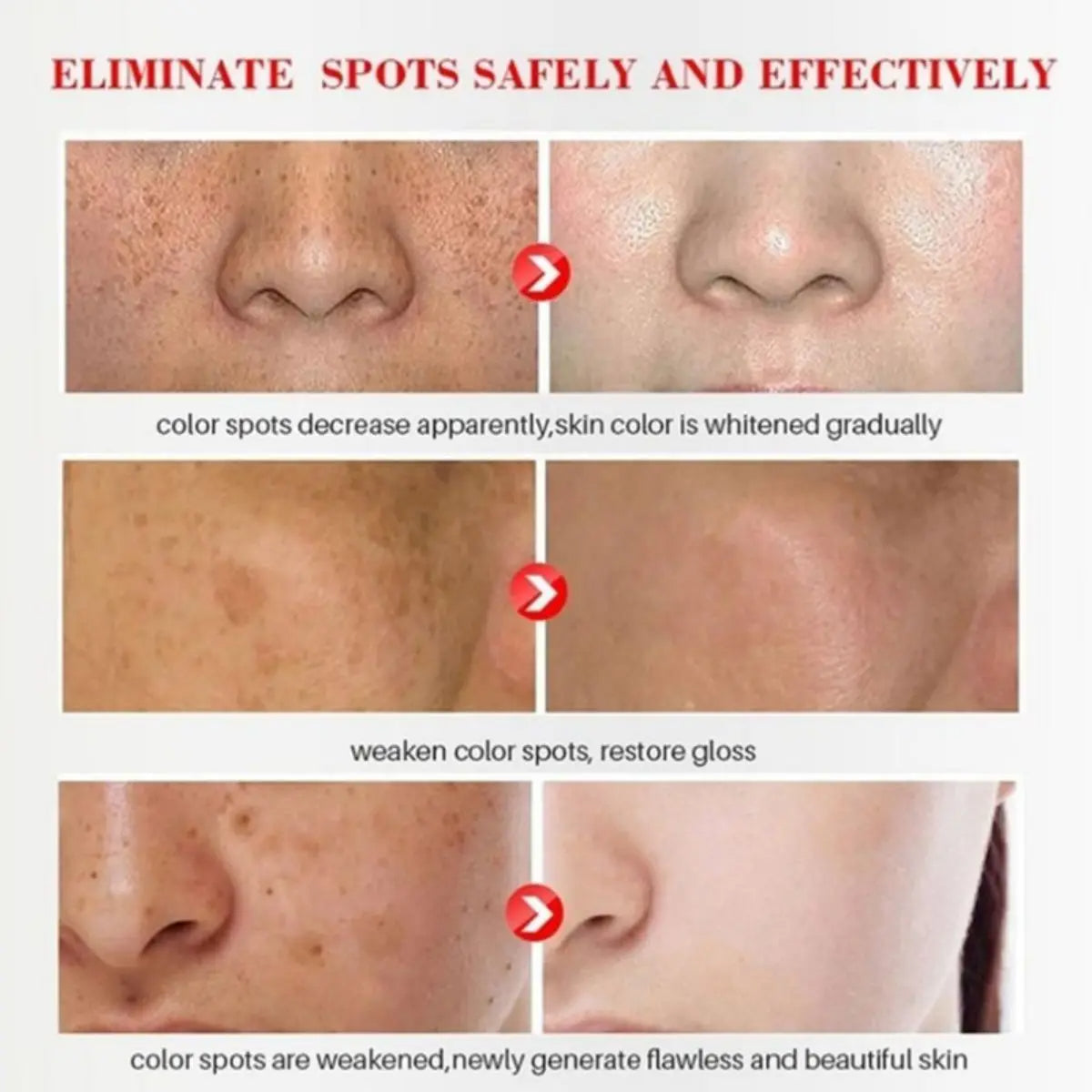 Acne Treatment Face Serum